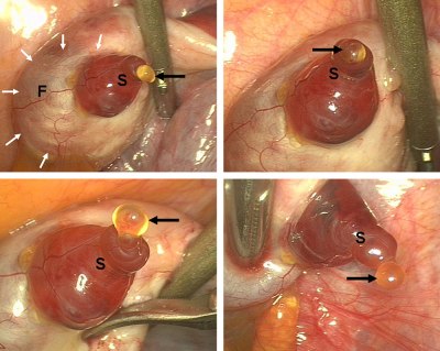 Jean-Christophe Lousse, Jacques Donnez Laparoscopic observation of spontaneous human ovulation. Fertil. Steril.: 2008, 90(3);833-4 PMID:18440526